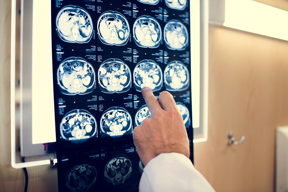 ​  Search to find out why men with prostate cancer are at higher risk of Alzheimer's