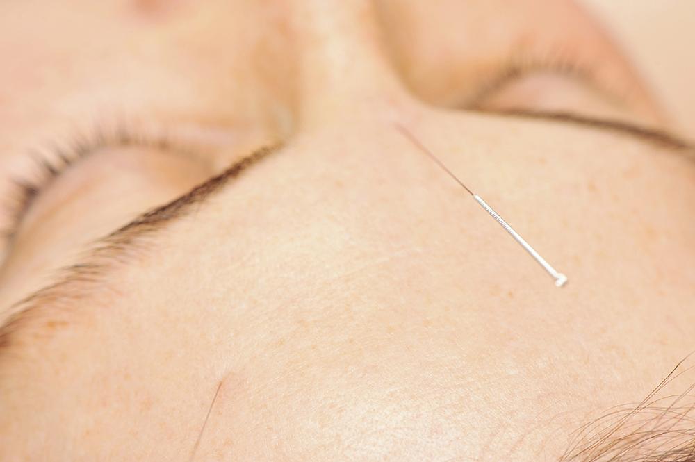 Acupuncture for Allergies 