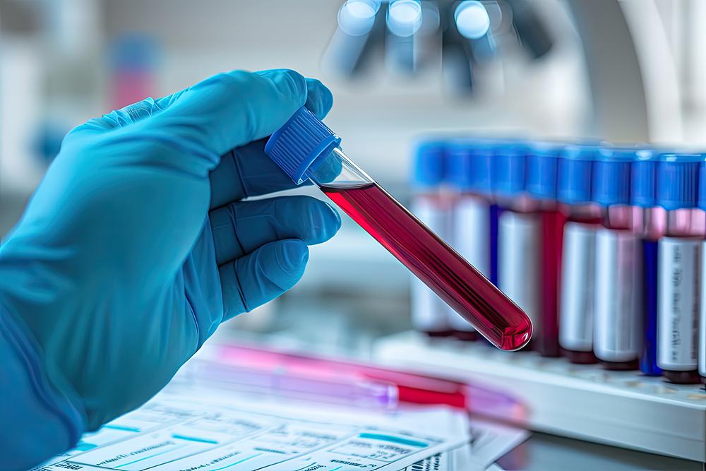 Análisis de sangre para cáncer de próstata igualmente efectivo